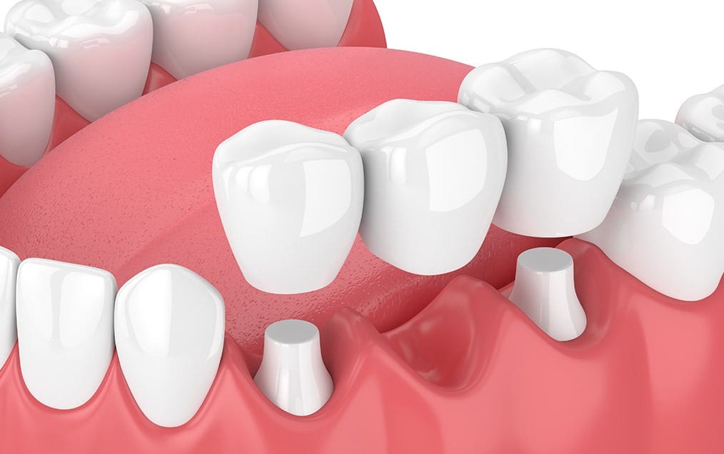 dental-bridges-team-smile-dentistry-fontham-pelham-general-and-family-dentist Dental Bridges | Team Smile Dentistry | General & Family Dentist | Fonthill | Ontario