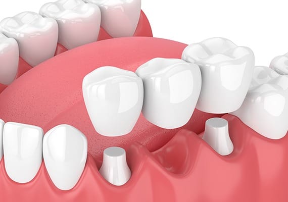 dental-bridges-team-smile-dentistry-fontham-pelham-general-and-family-dentist Dental Bridges | Team Smile Dentistry | General & Family Dentist | Fonthill | Ontario