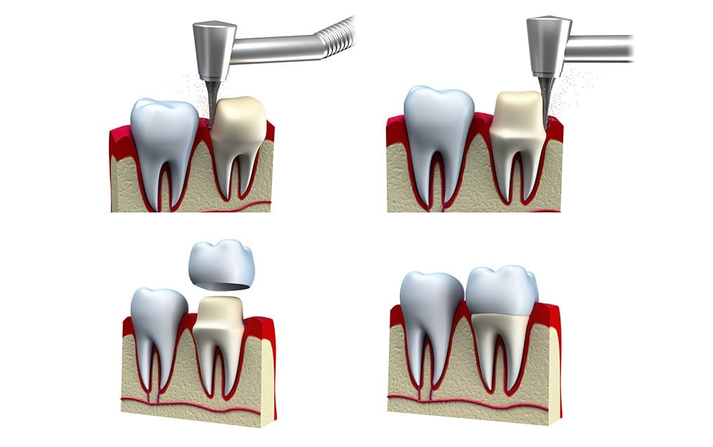 dental-crowns-process-team-smile-dentistry-fontham-pelham-general-and-family-dentist Dental Crowns | Team Smile Dentistry | General & Family Dentist | Fonthill | Ontario
