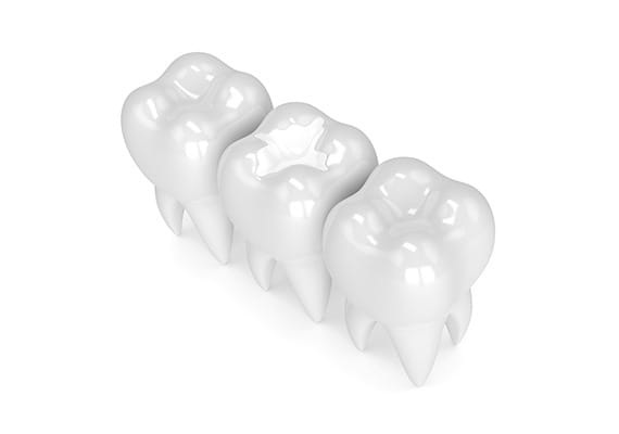 dental-fillings-team-smile-dentistry-fontham-pelham-general-and-family-dentist Dental Fillings | Team Smile Dentistry | General & Family Dentist | Fonthill | Ontario