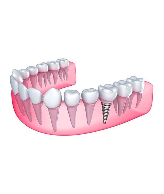 implant-dentistry-team-smile-dentistry-fontham-pelham-general-and-family-dentist