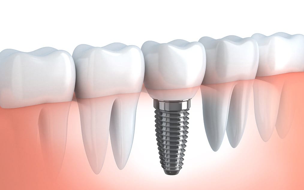 Implant Dentistry | Team Smile Dentistry | General & Family Dentist | Fonthill | Ontario