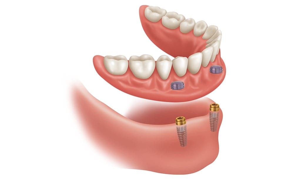 Over Denture Implants | Team Smile Dentistry | General & Family Dentist | Fonthill | Ontario