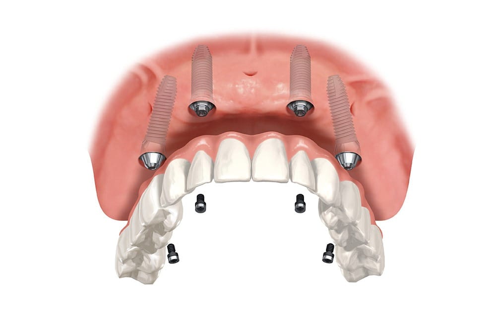 Over Denture Implants | Team Smile Dentistry | General & Family Dentist | Fonthill | Ontario