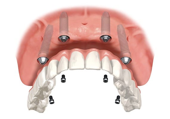 over-denture-implants-team-smile-dentistry-fontham-pelham-general-and-family-dentist Over Denture Implants | Team Smile Dentistry | General & Family Dentist | Fonthill | Ontario