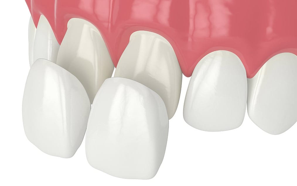 Porcelain Veneers | Team Smile Dentistry | General & Family Dentist | Fonthill | Ontario