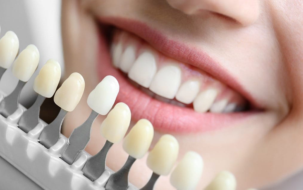 Porcelain Veneers | Team Smile Dentistry | General & Family Dentist | Fonthill | Ontario
