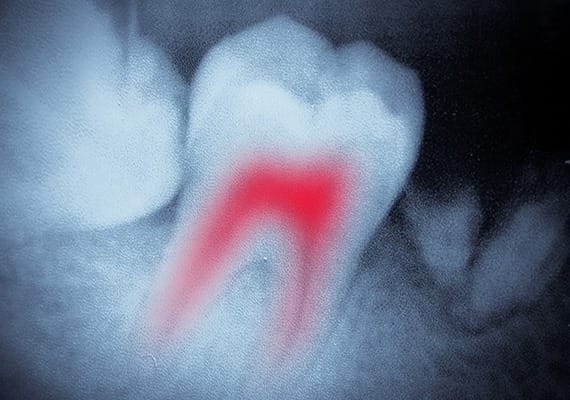 root-canal-therapy-team-smile-dentistry-fontham-pelham-general-and-family-dentist Root Canal Therapy | Team Smile Dentistry | General & Family Dentist | Fonthill | Ontario