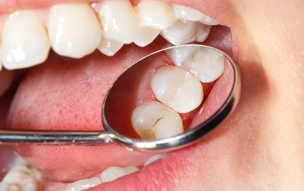 tooth-coloured-fillings-service-team-smile-dentistry-fontham-pelham-general-and-family-dentist Tooth Coloured Fillings | Team Smile Dentistry | General & Family Dentist | Fonthill | Ontario